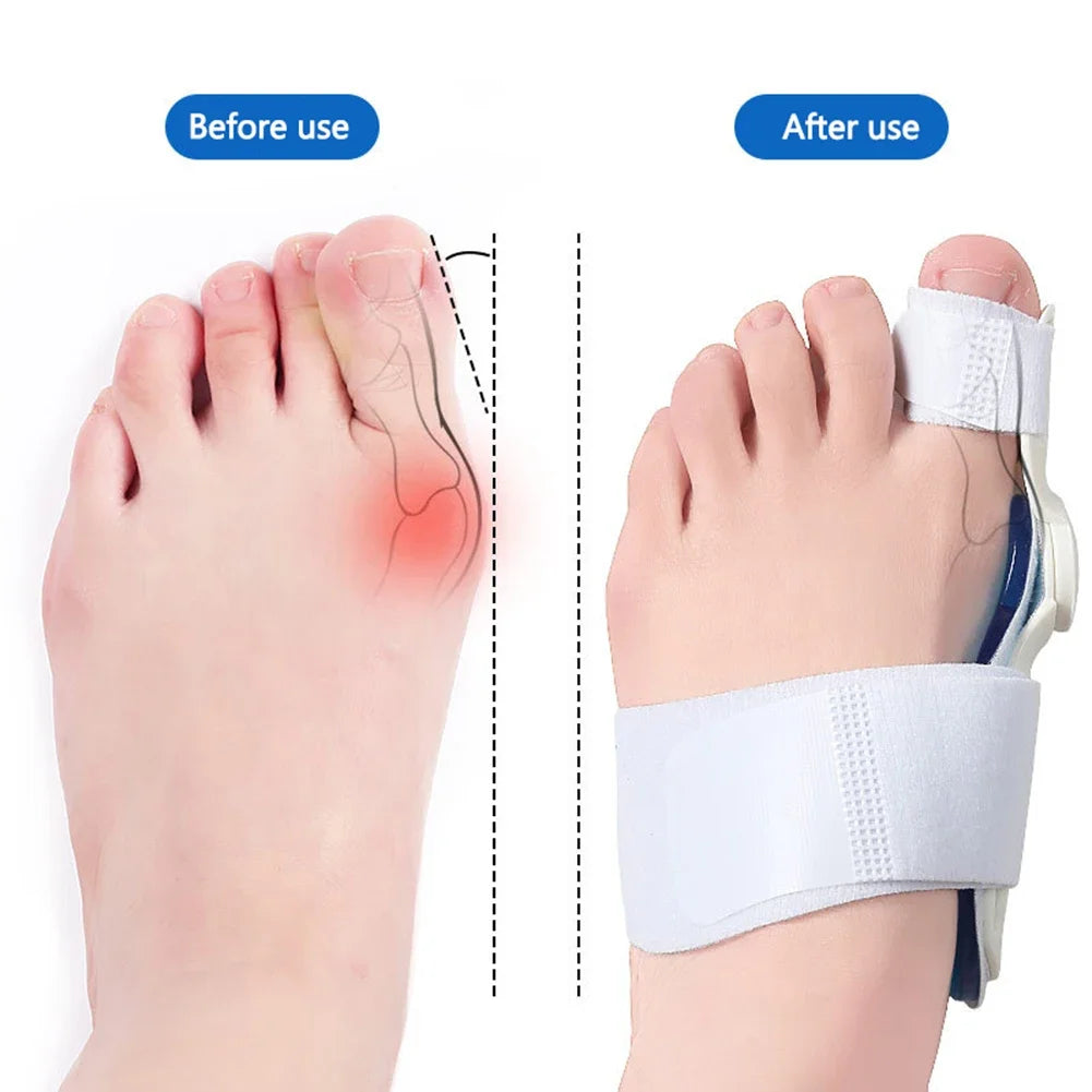 Bunion Corrector Adjustable Orthopedic Bunion Toe Straightener Hallux Valgus Corrector for Big Toe Bunion Relief