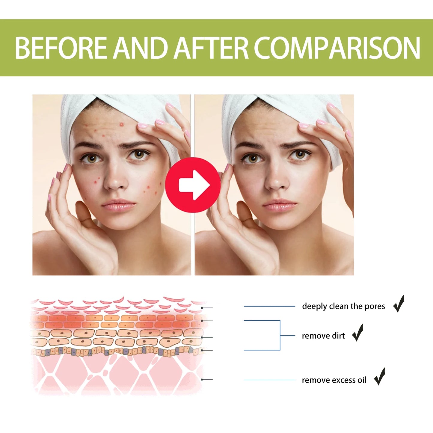 Eelhoe Tea Tree Oil Essence For Acne Scar Reduction Serum