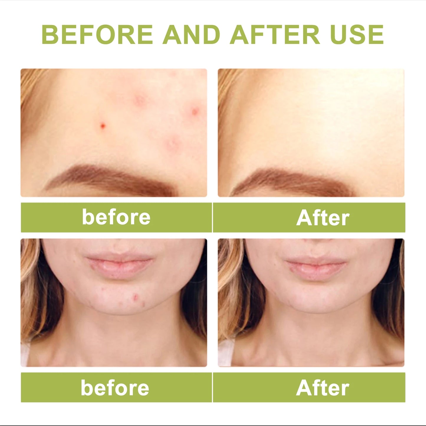 Eelhoe Tea Tree Oil Essence For Acne Scar Reduction Serum