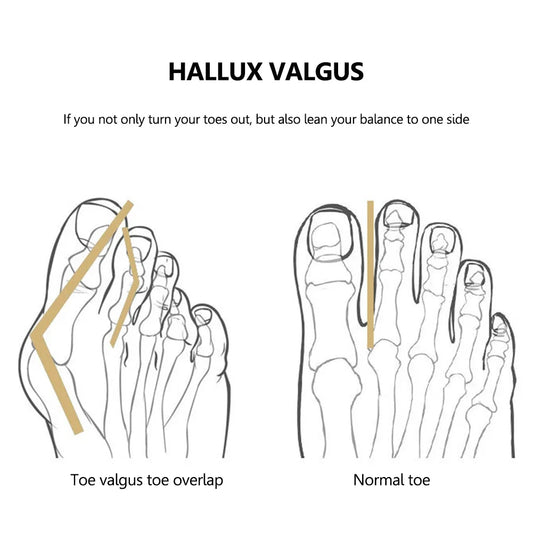 Bunion Corrector Adjustable Orthopedic Bunion Toe Straightener Hallux Valgus Corrector for Big Toe Bunion Relief